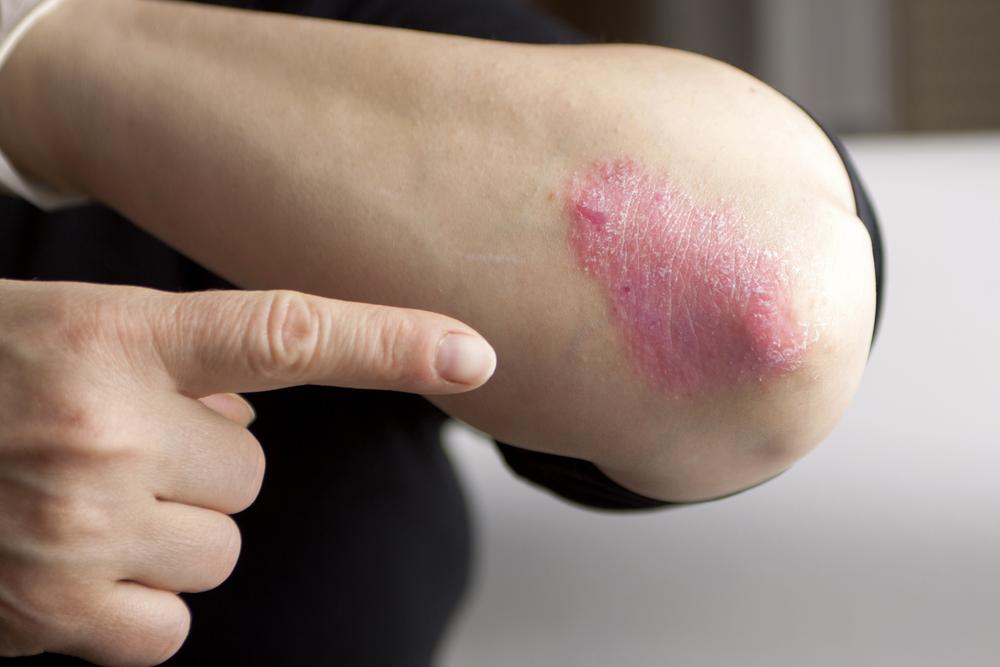 Poor Stress Coping Skills Tied to Increased Risk of Psoriasis: Study