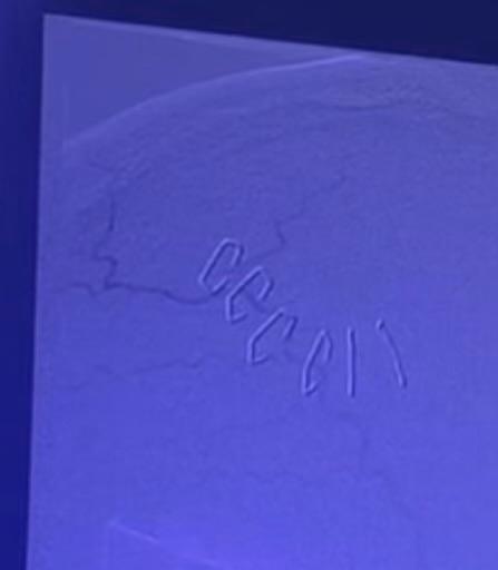 Attorney Bradley Gage presented a CT scan image of Los Angeles Police Department officer Houston Ryan Tipping's head injuries at a news conference on July 5, 2022. (Courtesy of Bradley Gage)