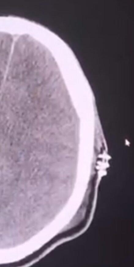 During a news conference on the training death of Los Angeles Police Department officer Houston Ryan Tipping, attorney Bradley Gage presented a CT scan image in Woodland Hills on July 5, 2022. (Courtesy of Bradley Gage)