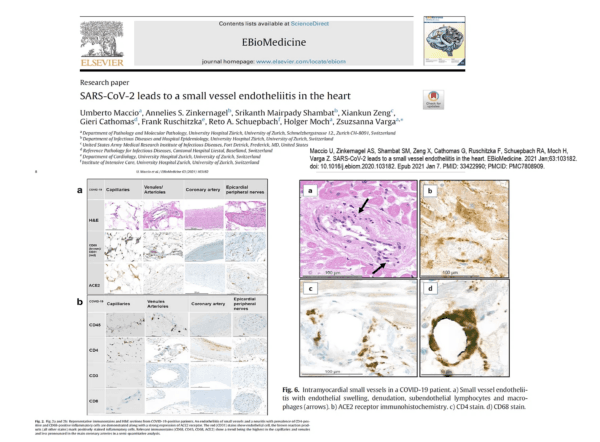 Maccio U, Zinkernagel AS, Shambat SM, Zeng X, Cathomas G, Ruschitzka F, Schuepbach RA, Moch H, Varga Z. SARS-CoV-2 leads to a small vessel endotheliitis in the heart. EBioMedicine. 2021 Jan;63:103182. doi: 10.1016/j.ebiom.2020.103182. Epub 2021 Jan 7. PMID: 33422990; PMCID: PMC7808909.