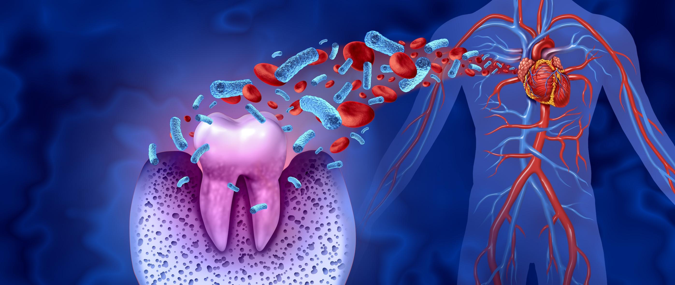 Treating Gum Disease May Prevent Return of Irregular Heartbeat: Study