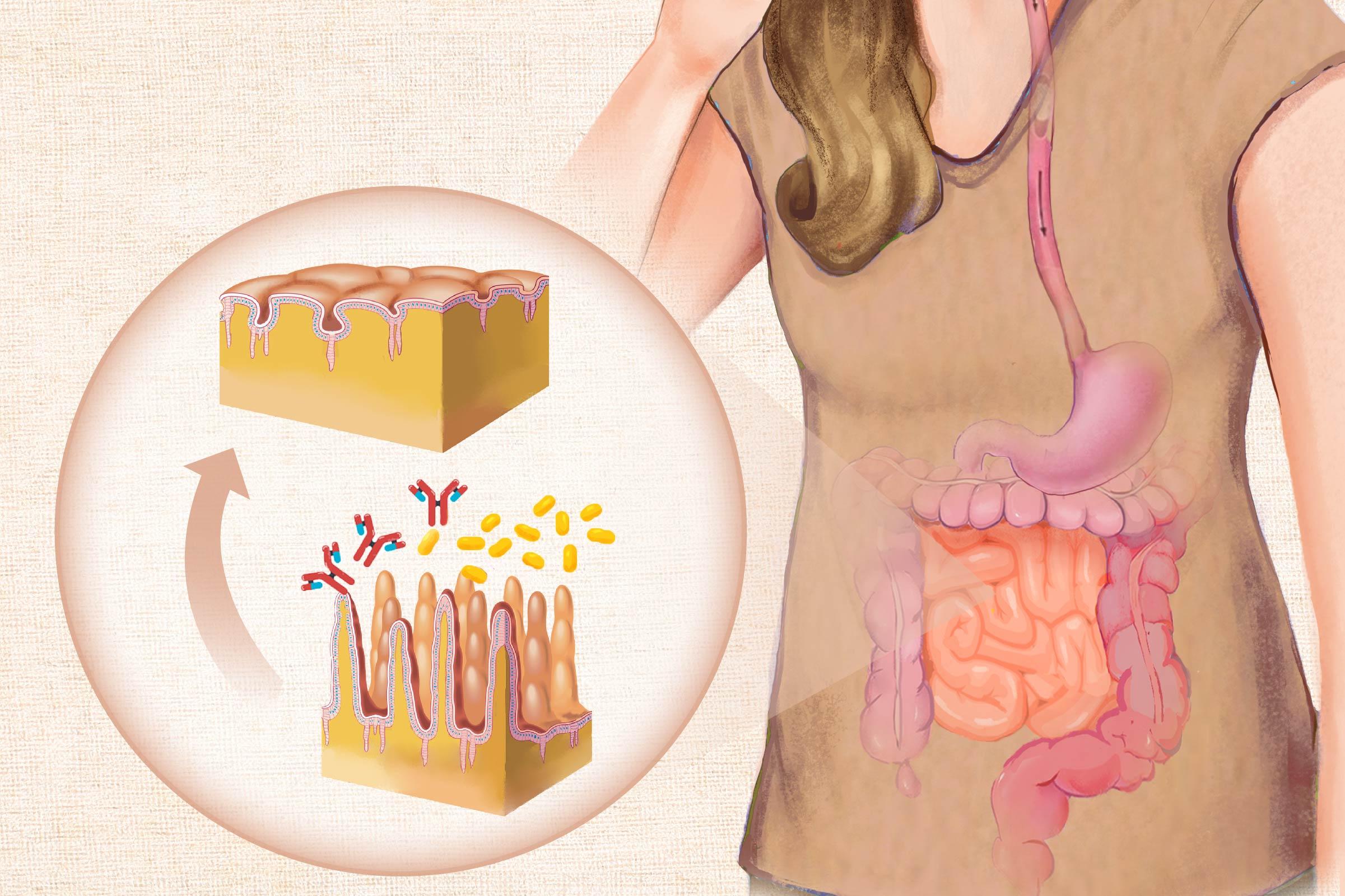 Celiac Disease: Symptoms, Causes, Treatments, and Natural Approaches