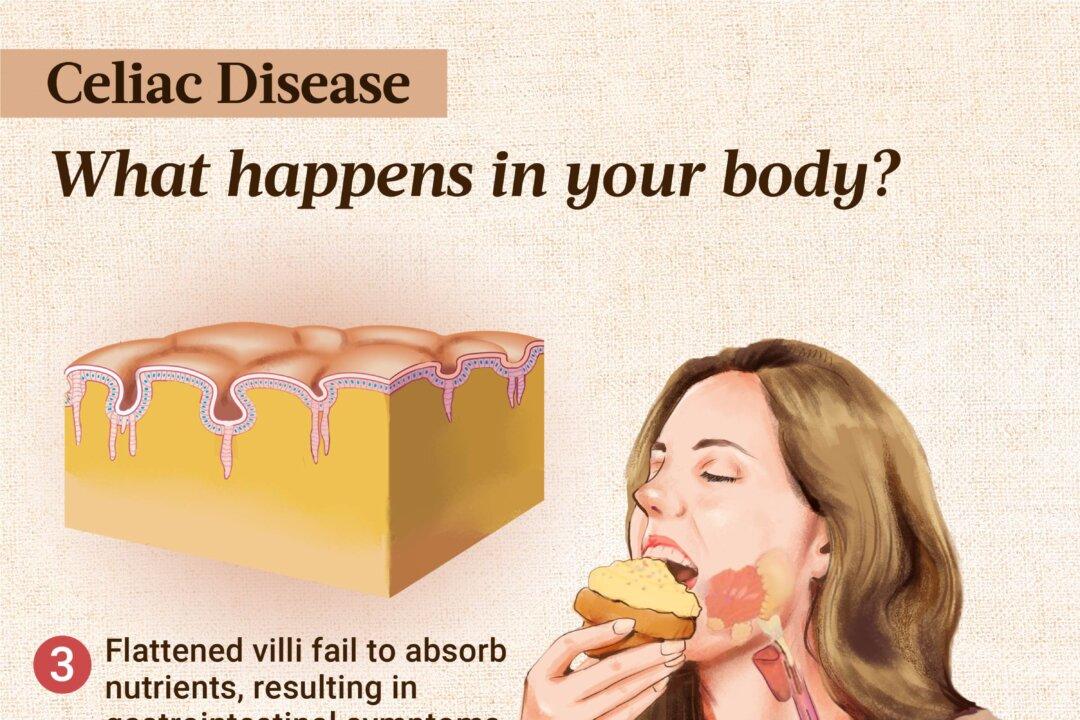 In predisposed individuals, the immune system mistakenly attacks gluten, damaging the intestinal lining in the process. This autoimmune attack flattens intestinal villi, making it so the body cannot absorb nutrients and causing gastrointestinal symptoms. (Illustration by The Epoch Times, Shutterstock)