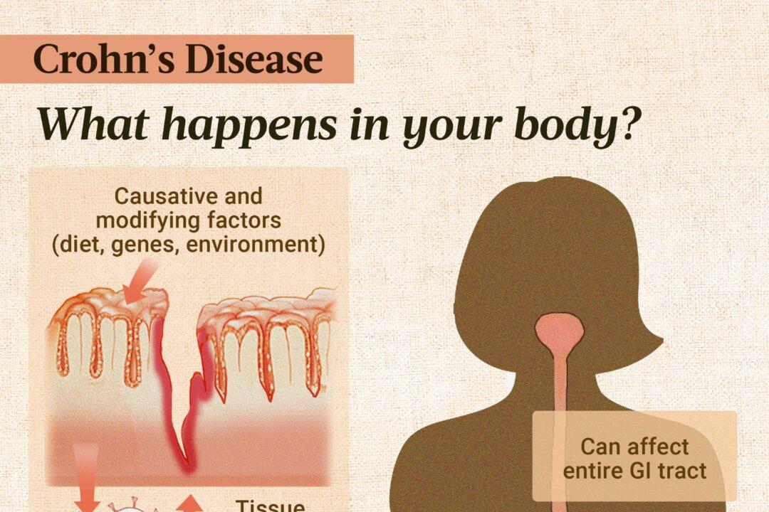 Several factors, including genetic, environmental, and diet, can influence the development of Crohn's disease, which results from an inappropriate immune response and can affect the entire gastrointestinal tract. (Illustration by The Epoch Times, Shutterstock)