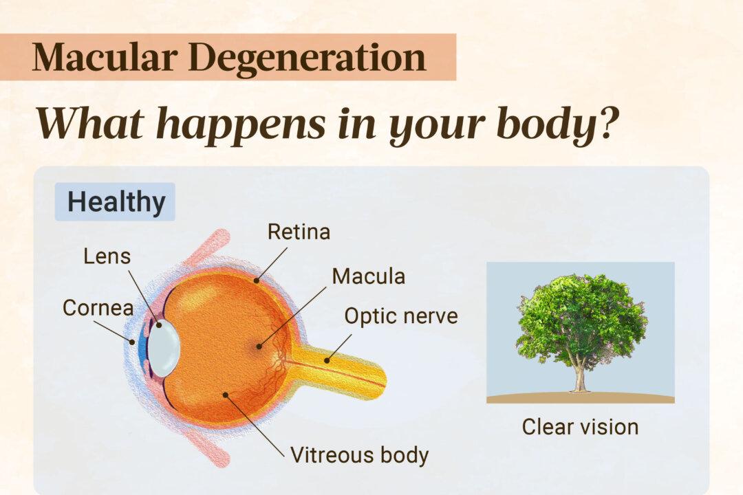 Age-related macular degeneration occurs when the retinal pigment epithelium becomes less efficient at supplying nutrients and removing waste. This causes the formation of drusen, protein deposits that interfere with vision. In wet AMD, abnormal blood vessel growth causes leakage, resulting in a dark spot in the center of the visual field. (Illustration by The Epoch Times, Shutterstock)