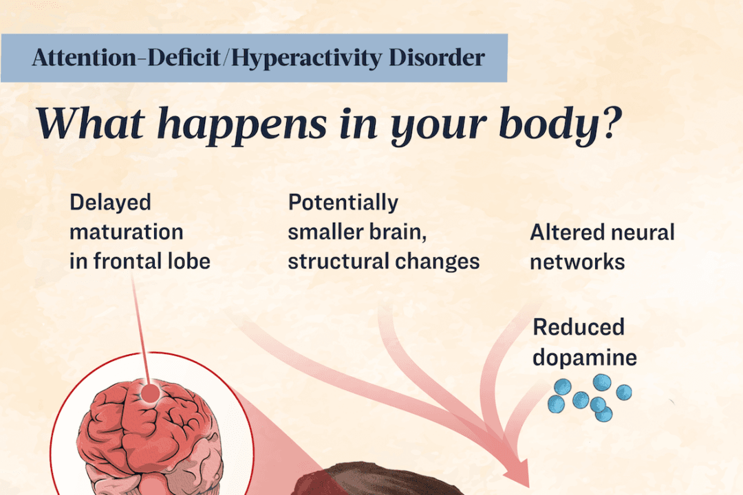 Influenced by genetics and environmental factors, changes in the brain, including size and maturation, are implicated in the development of ADHD. (Illustration by The Epoch Times, Shutterstock)