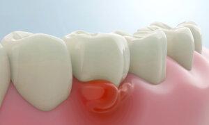 New Antibiotic Fights Severe Gum Disease