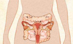 Endometriosis: Symptoms, Causes, Treatments, and Natural Approaches