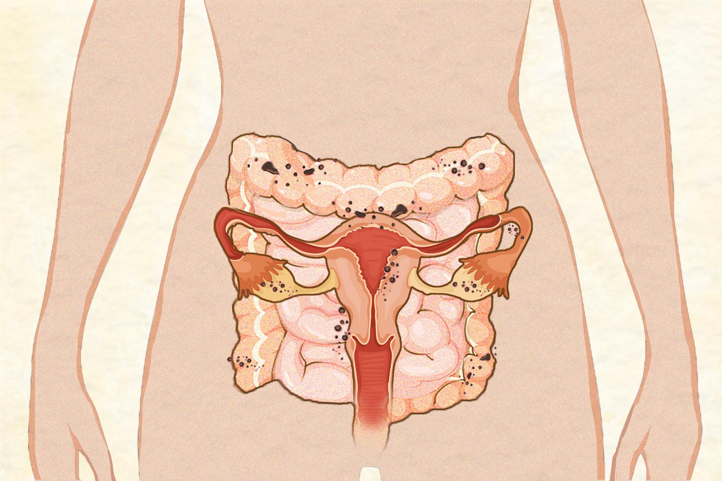 Endometriosis: Symptoms, Causes, Treatments, and Natural Approaches