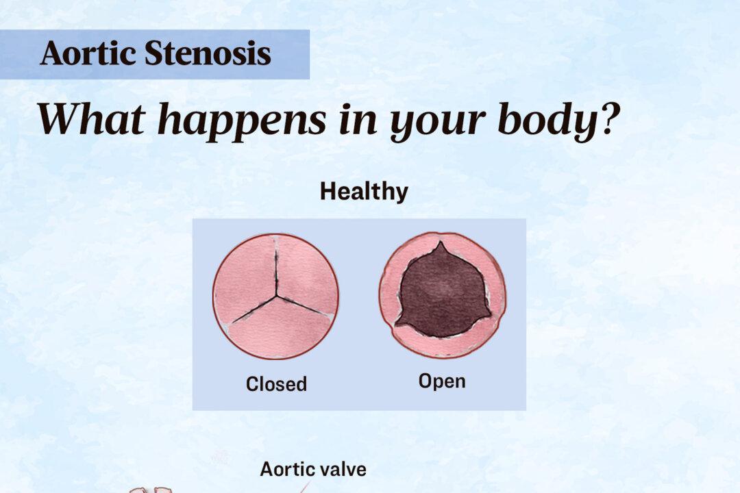 In aortic stenosis, the aortic valve becomes stiff or scarred due to a birth defect or buildup of calcium, impeding blood flow from the heart to the rest of the body. (Illustration by The Epoch Times, Shutterstock)