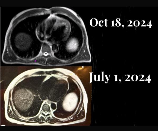 Before and after MRIs depicting fat decrease after 3.5 months. (Courtesy of Dr. Sean O’Mara)