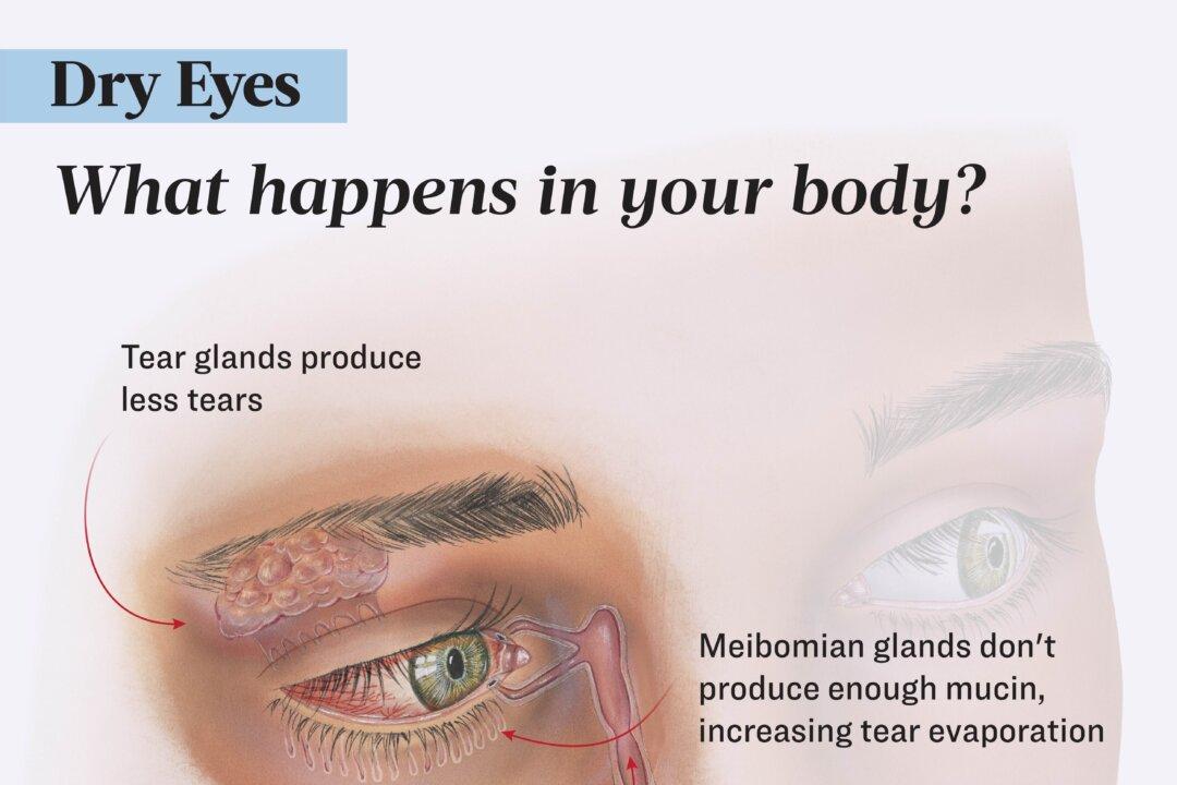 Dry eye syndrome has two main causes: insufficient tear production and rapid tear evaporation. (Illustration by The Epoch Times, Shutterstock)