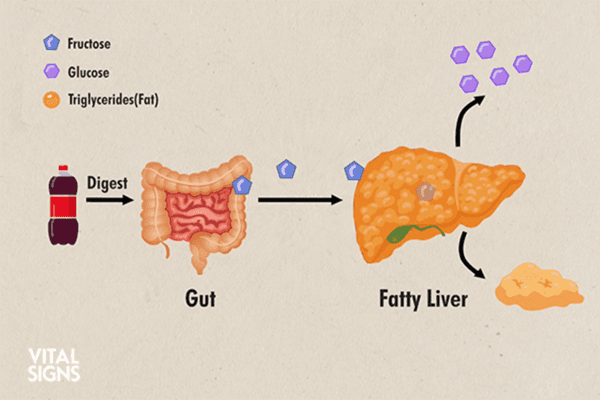 Dr. Jason Fung says excess fructose contributes to fatty liver disease in “Silent Sugar” on “Vital Signs.”