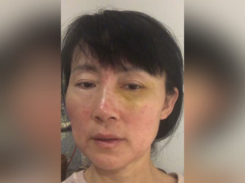 Zhang Chunping, a Falun Gong practitioner who was assaulted in London on Feb. 23, 2026. (Courtesy of Zhang Chunping)
