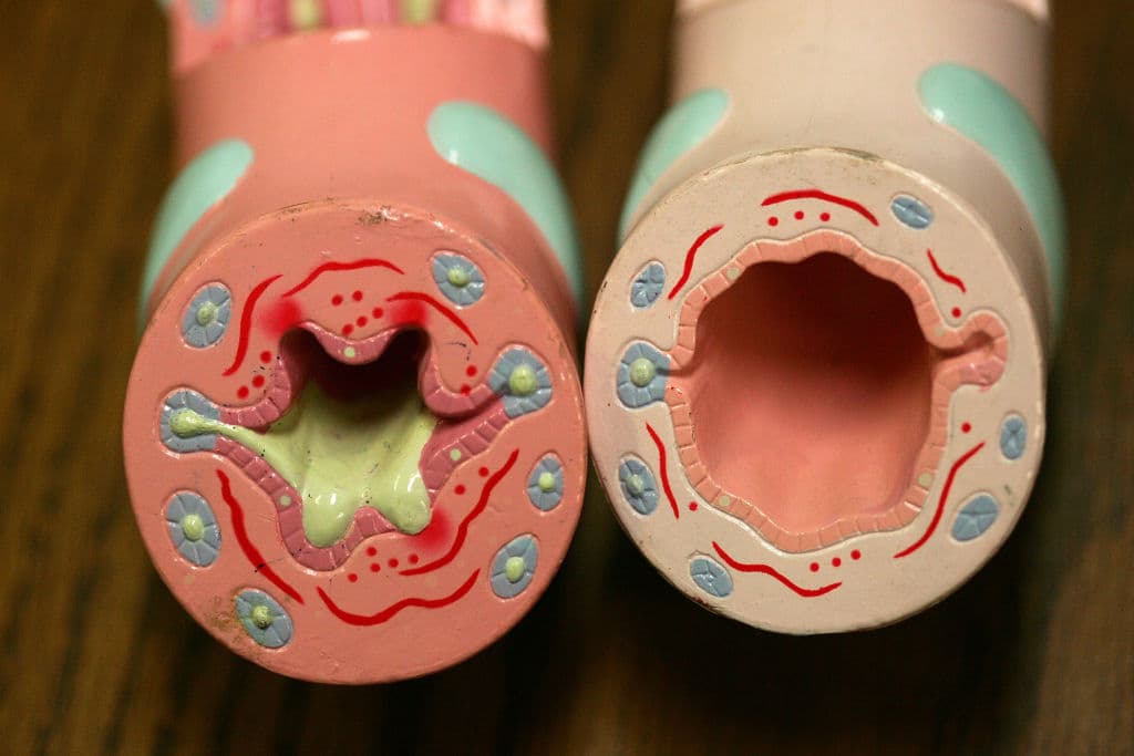 Models demonstrate the difference between a healthy airway and one inflamed by asthma at the Venice Family Clinic in the Los Angeles community of Venice, on June 6, 2007. (David McNew/Getty Images)