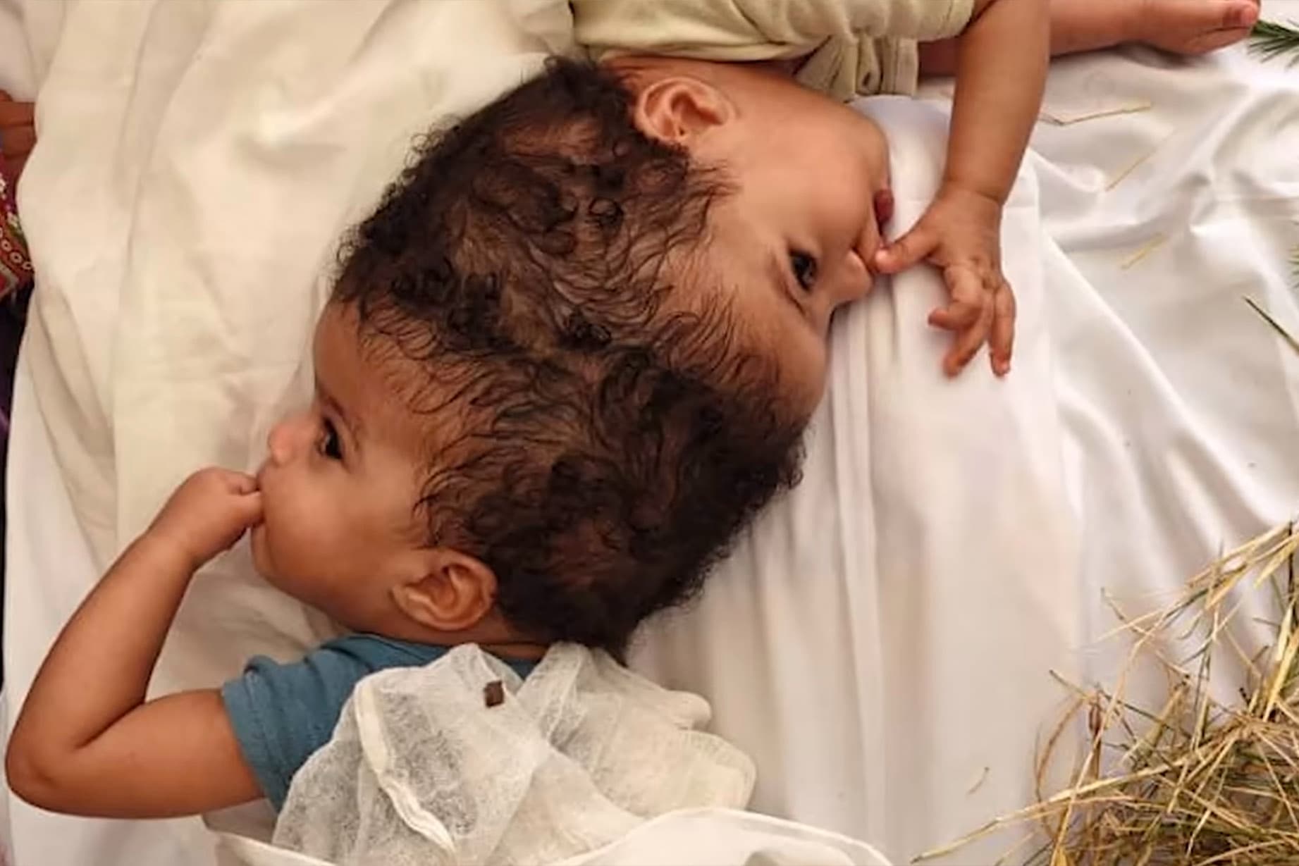 The conjoined twins lie together early in their medical journey. (SSM Health Cardinal Glennon Children's Hospital)