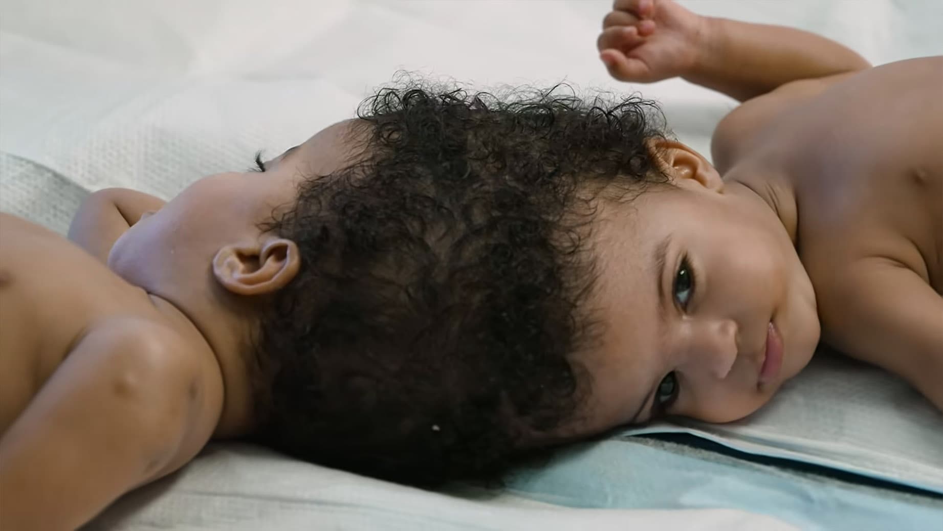 Twin sisters Hiyab and Wuhbto were born conjoined at the crown of their skulls. (SSM Health Cardinal Glennon Children's Hospital)