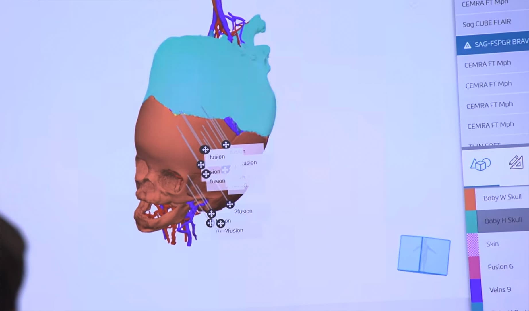 A digitized 3D rendering displays the intricate cranial and vascular anatomy of the conjoined twins. (SSM Health Cardinal Glennon Children's Hospital)