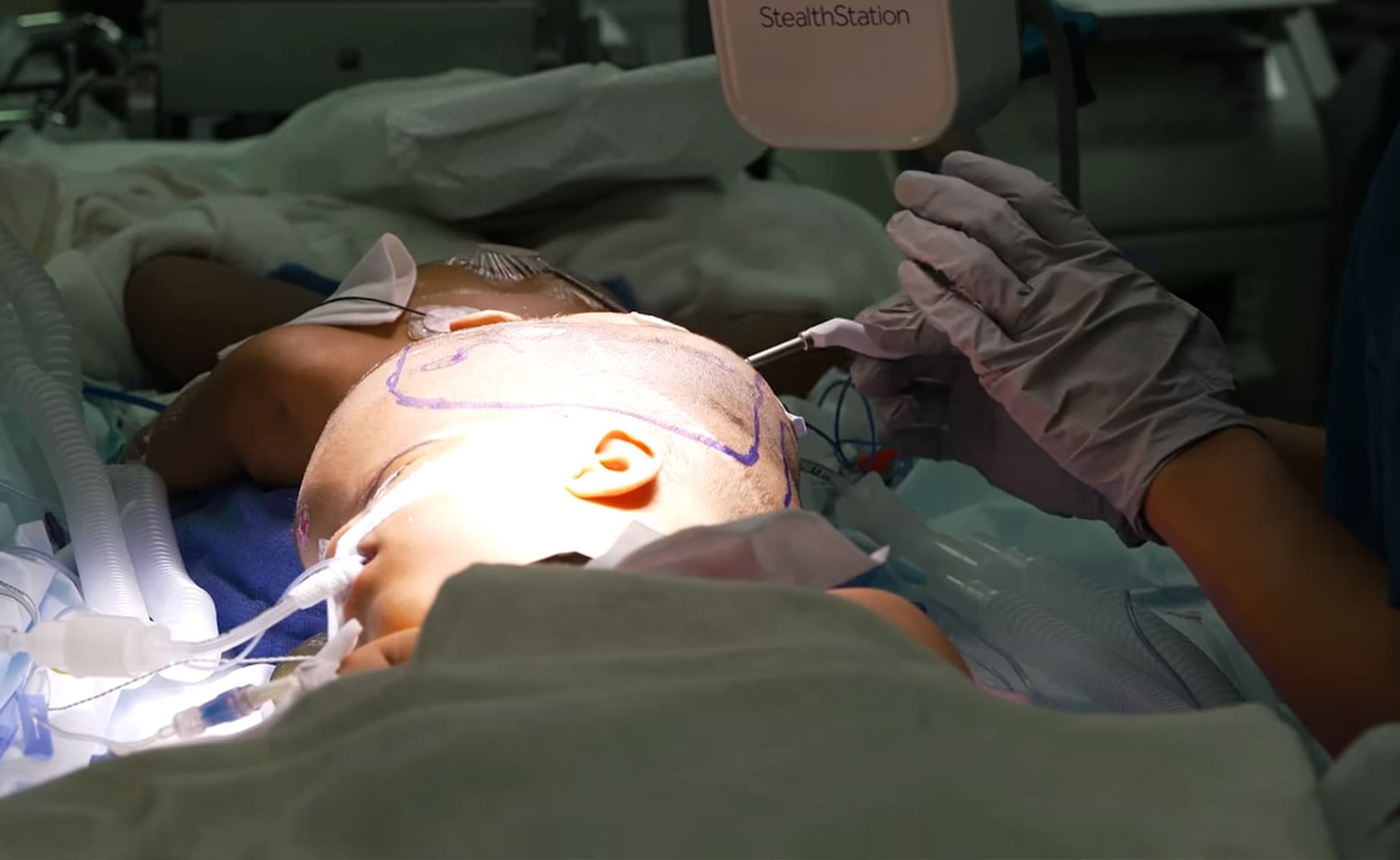 Members of a 60-person multi-disciplinary medical team prepare the operating theater on Feb. 24, 2026, moments before beginning the final separation procedure. (SSM Health Cardinal Glennon Children's Hospital)