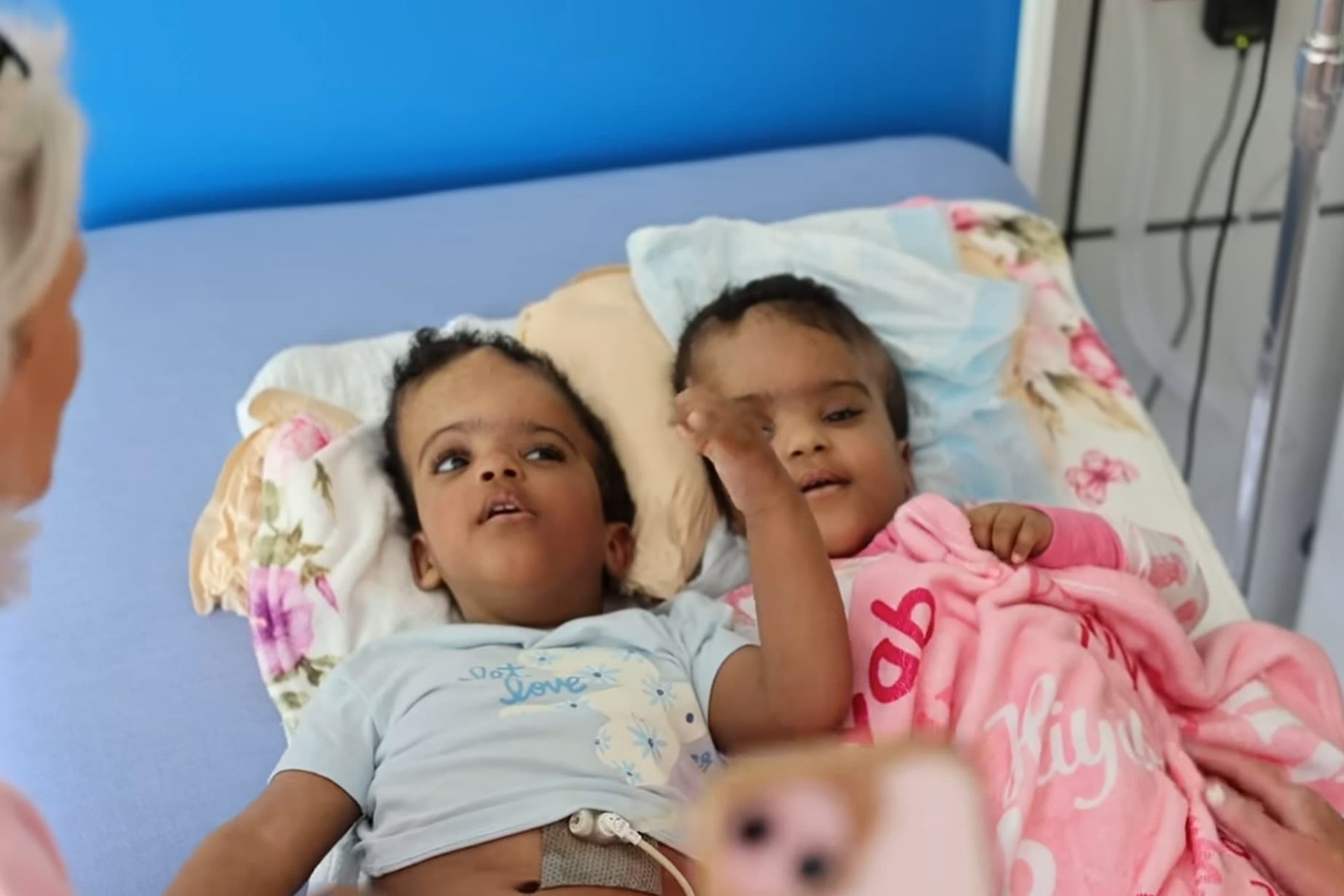 Hiyab and Wuhbto lie side-by-side during a post-operative visit following their historic cranial separation. (SSM Health Cardinal Glennon Children's Hospital)