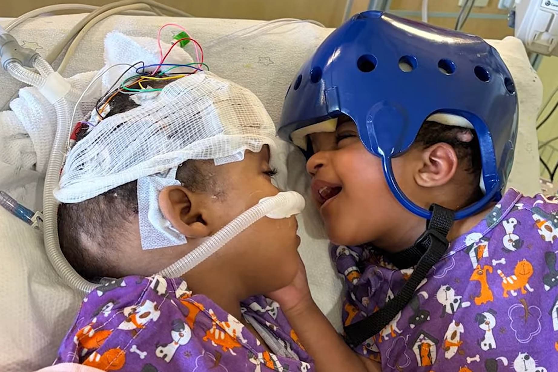 Twin sisters Hiyab and Wuhbto interact in a hospital recovery room following their successful separation. (SSM Health Cardinal Glennon Children's Hospital)