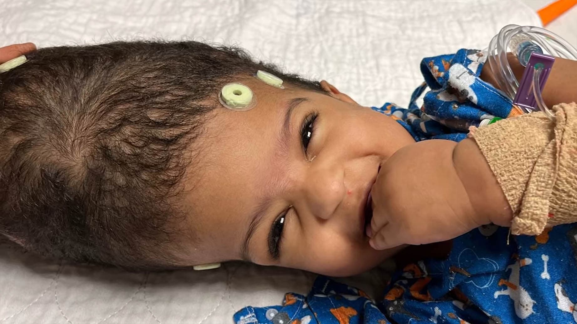 A close-up photograph captures the smile of one of the twins prior to her historic 25-hour separation surgery. (SSM Health Cardinal Glennon Children's Hospital)