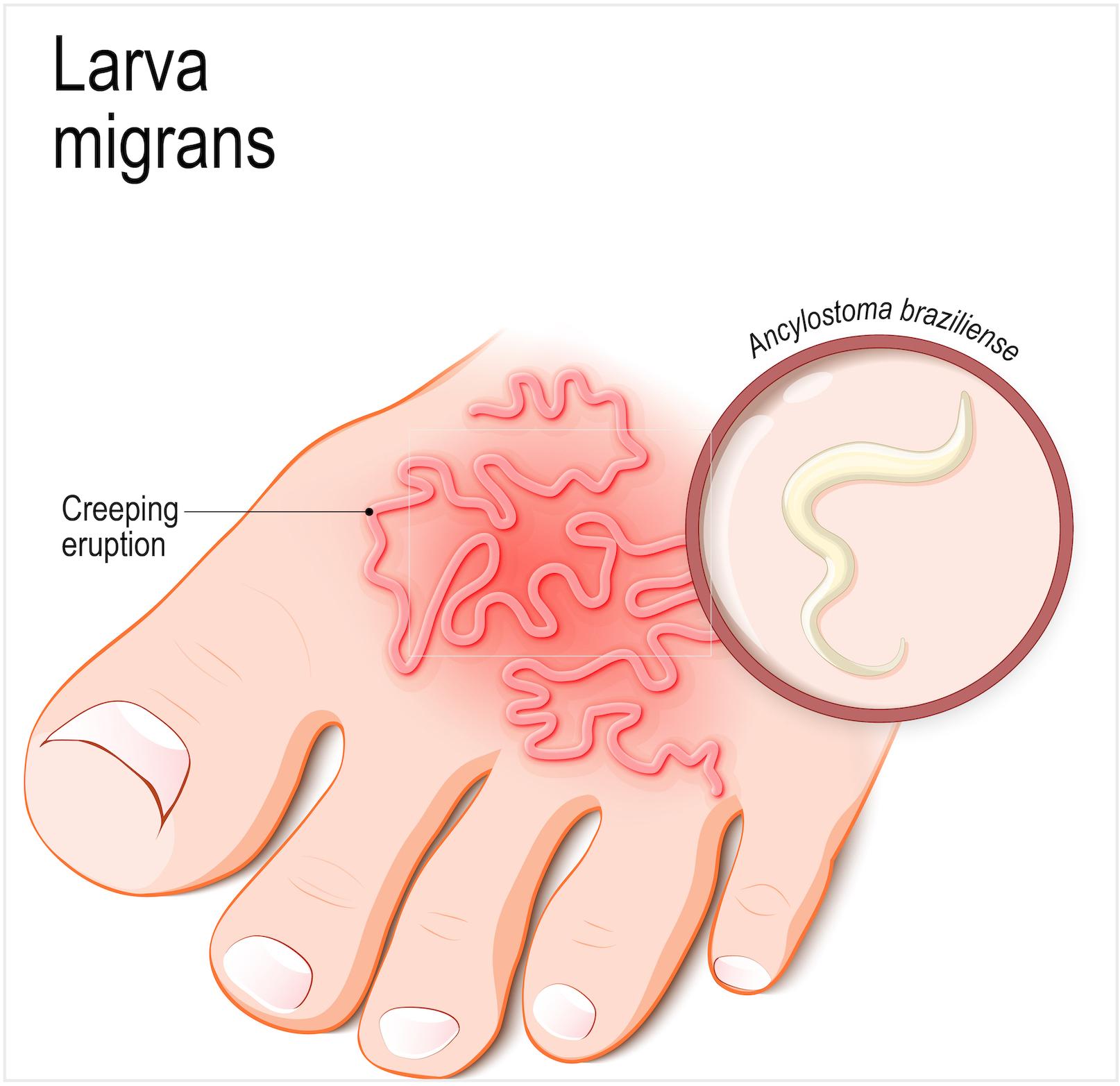 Illustration - Shutterstock | <a href="https://www.shutterstock.com/image-vector/cutaneous-larva-migrans-skin-disease-humans-1254209356">Designua</a>