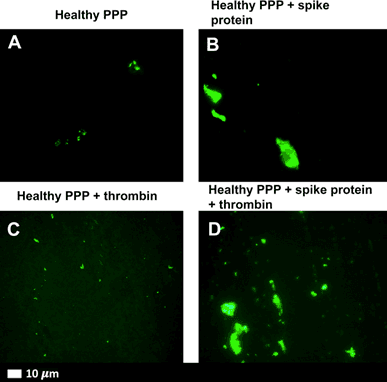 Figure 1. Amyloid clots formed in response to spike protein S1. (National Center for Biotechnology Information)
