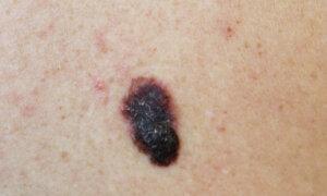 FDA Approves 1st T-Cell Therapy for Melanoma