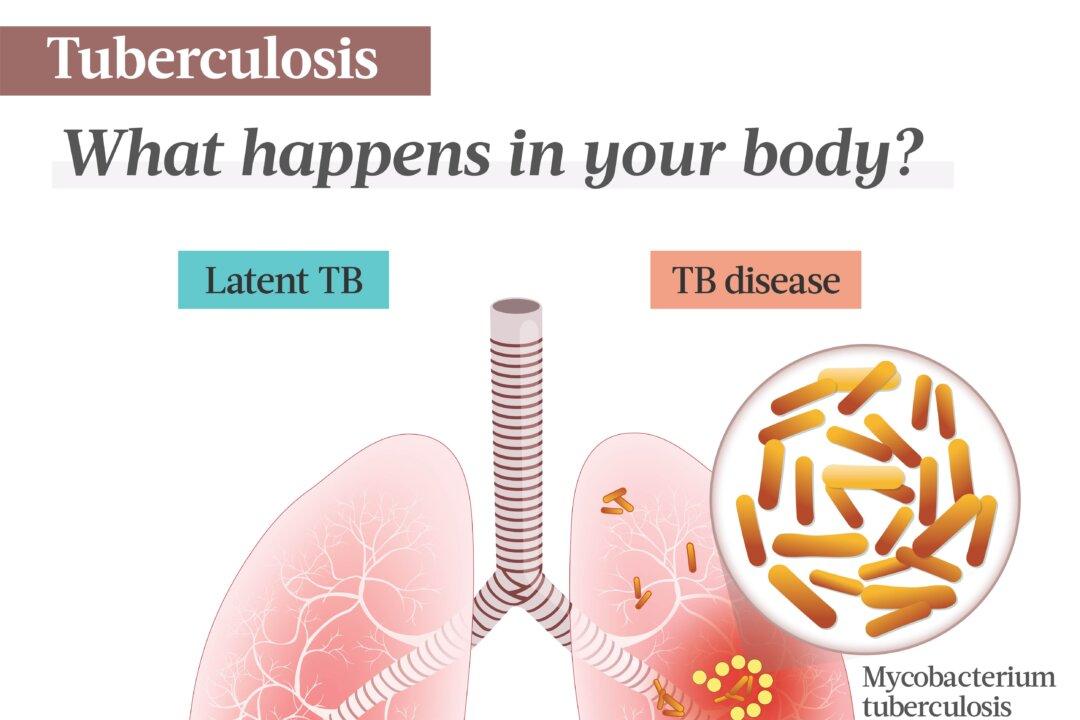 (Tuberculosis is caused by bacteria. An infection won't always develop into disease; often, the TB bacteria will live dormant in the body. (Illustrations by The Epoch Times, Shutterstock)