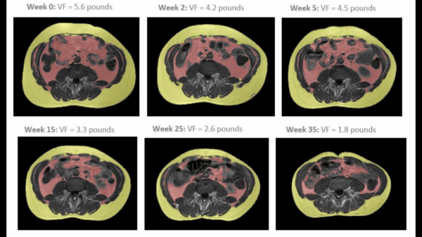 MRIs depicting gradual reduction in heart fat from zero to 35 weeks. (Courtesy of Dr. Sean O’Mara)