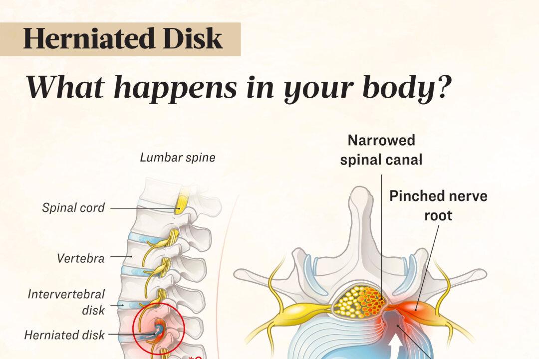 A herniated disk is usually due to age-related degeneration, typically in the lower or upper back. (Illustration by The Epoch Times, Shutterstock)