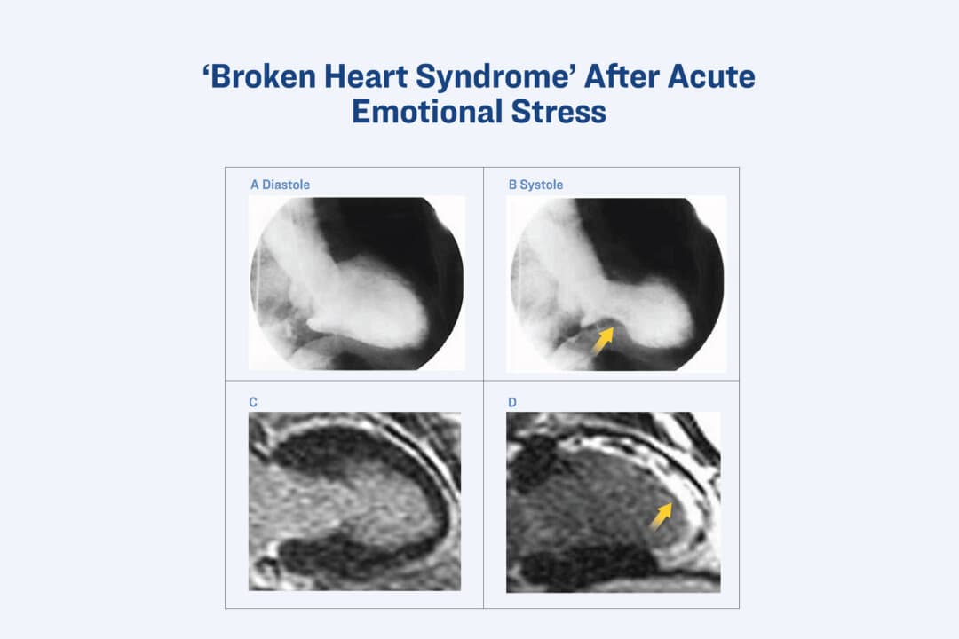 Panels A and B show that during broken heart syndrome, parts of the heart stop contracting but remain viable. Panel C confirms the heart muscle in these areas is healthy and can recover. Panel D, for comparison, demonstrates permanent damage to the heart muscle from a heart attack. (Courtesy of The New England Journal of Medicine ©2005)