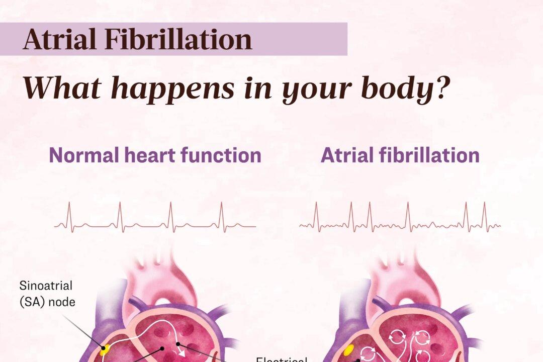 In atrial fibrillation, the electrical signals in the atria become disorganized, causing the upper chambers to quiver or fibrillate. (Illustration by The Epoch Times, Shutterstock)
