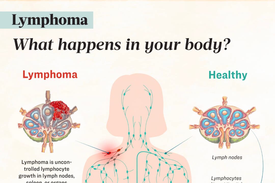 Lymphoma progresses through four stages, starting in a single lymph node region and potentially spreading to organs like the liver, lungs, and bone marrow. (Illustration by The Epoch Times, Shutterstock)