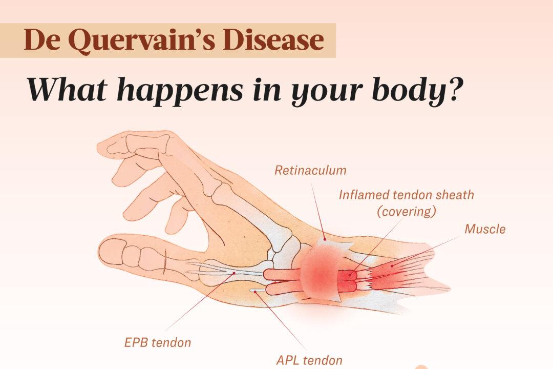 De Quervain's disease causes inflammation of the extensor pollicis brevis (EPB) and abductor pollicis longus (APL) tendons, causing pain when moving the thumb or wrist. (The Epoch Times/Shutterstock)