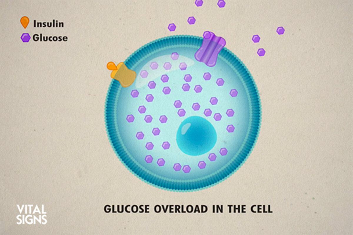 Type 2 diabetes is caused by overloading cells with glucose, not cell dysfunction, says Dr. Jason Fung in “<span style="font-weight: 400;"><a href="https://ept.ms/ReverseDiabetes_VS" target="_blank" rel="nofollow noopener">Reverse Type 2 Diabetes</a></span> on “<span style="font-weight: 400;"><a href="https://www.theepochtimes.com/epochtv/vital-signs" target="_blank" rel="nofollow noopener">Vital Signs.</a>”</span>