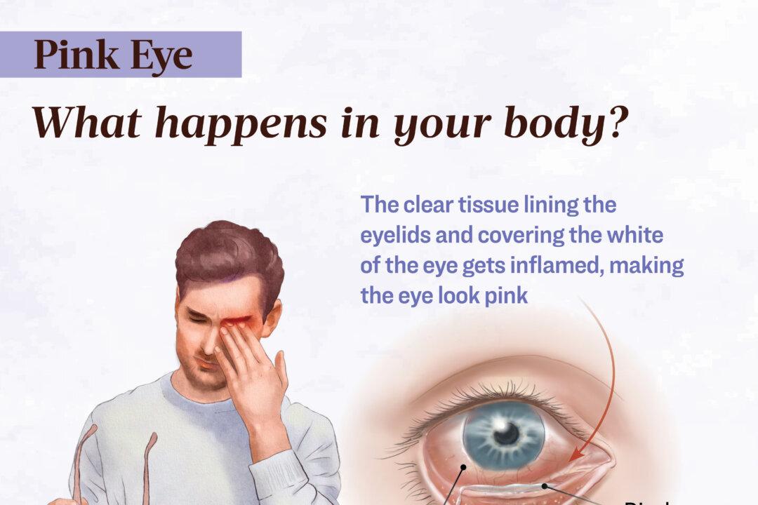 Pink eye happens when the conjunctiva becomes inflamed due to infection, allergens, or irritants. (The Epoch Times/Shutterstock)