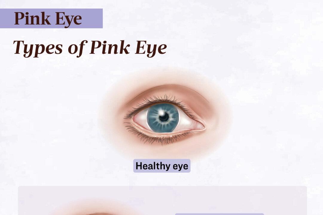 Pink eye can be caused by viruses, bacteria, or allergens—each with slightly different symptoms and treatments. (The Epoch Times/Shutterstock)