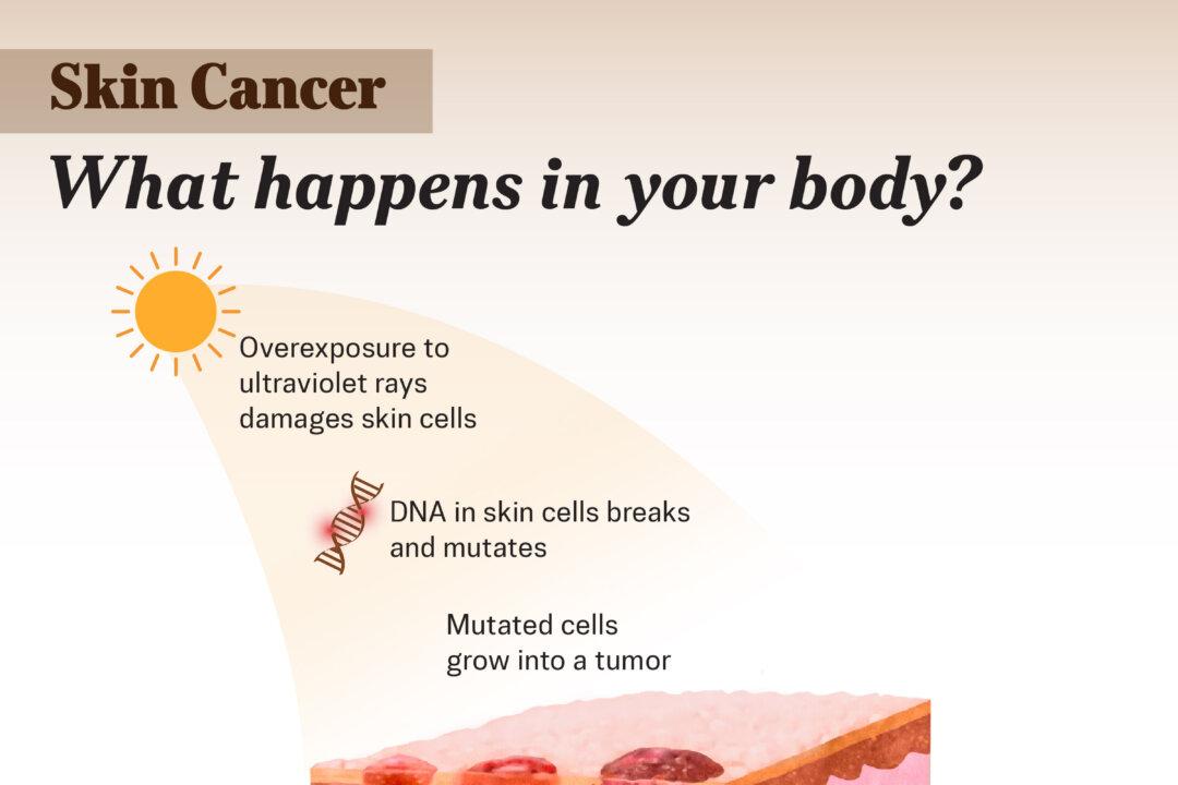 Harmful ultraviolet (UV) rays can damage skin cells and trigger mutations that lead to skin cancer. Illustration by The Epoch Times, Shutterstock