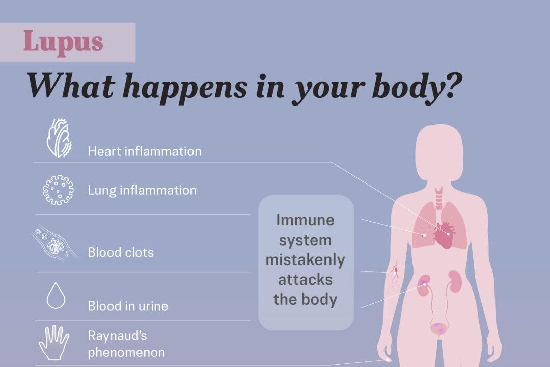 Lupus is an autoimmune disease where the immune system mistakenly attacks the body’s own healthy tissues. Illustration by The Epoch Times, Shutterstock