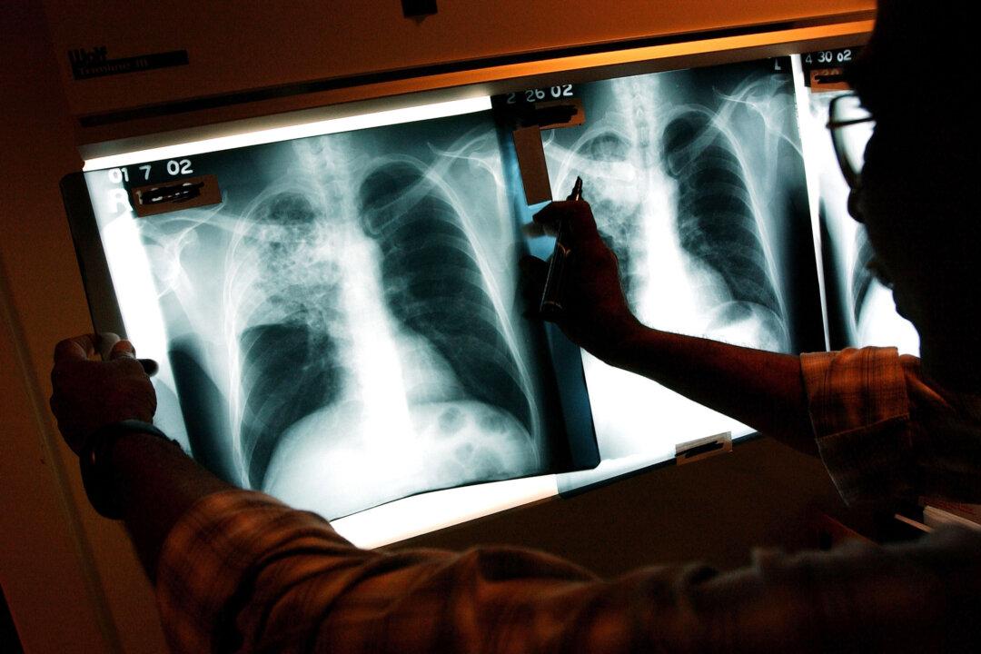 A doctor examines the X-rays of a tuberculosis patient at a clinic in the Brooklyn borough of New York City on Nov. 27, 2002. According to the WHO, tuberculosis was the world’s leading infectious disease killer in 2023, surpassing COVID-19. (Spencer Platt/Getty Images)