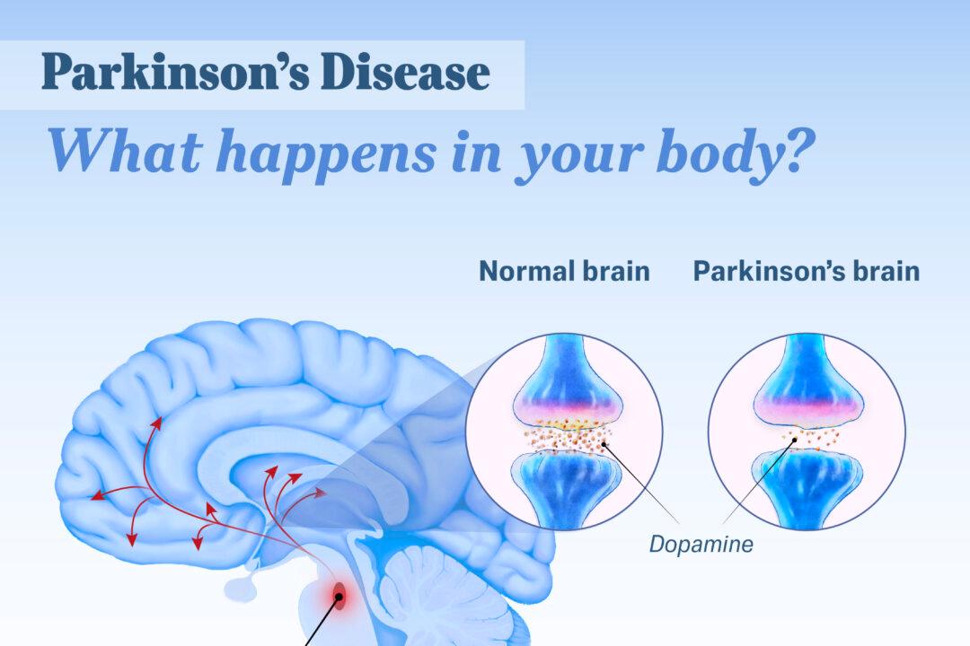 Parkinson's disease causes a loss of dopamine-producing brain cells, disrupting movement and emotional control. (Illustration by The Epoch Times, Shutterstock)