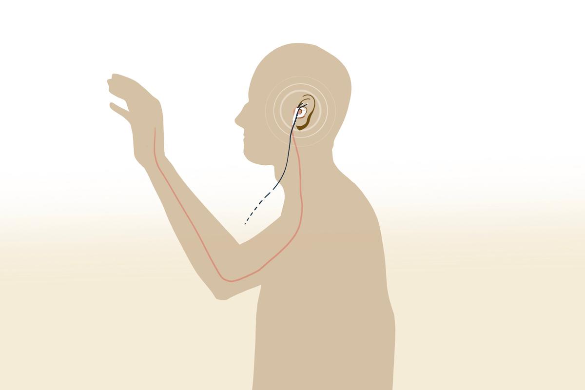 The tVNS device and how it may help restore arm function after a stroke. (Illustration by The Epoch Times)