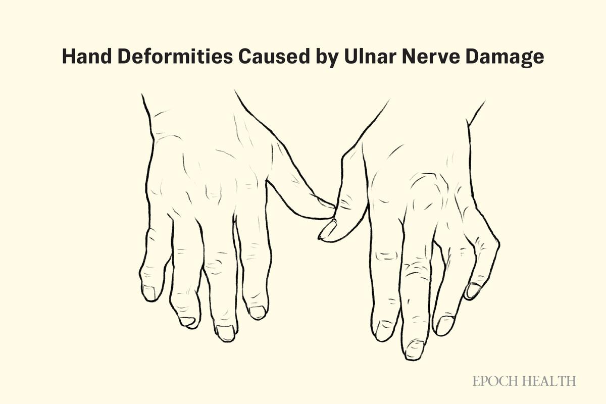 Diabetic peripheral neuropathy. (The Epoch Times)