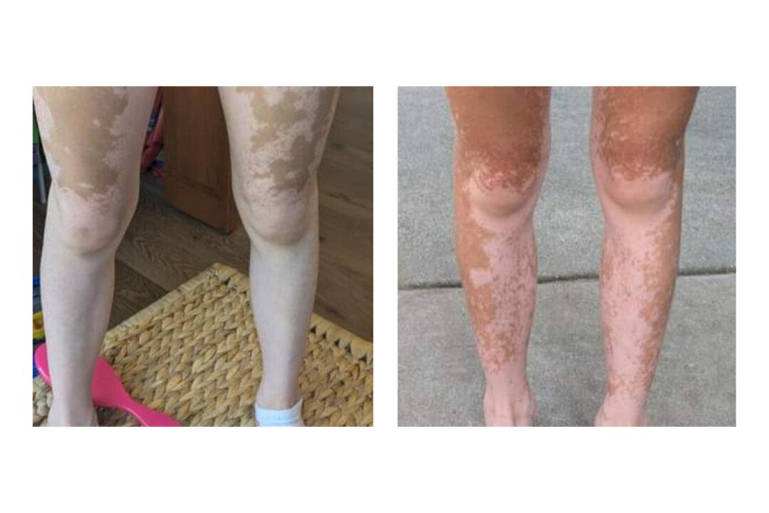 Pigmentation began to reappear in Cami's skin, right, months after moving out of the moldy environment. (Photo by Megan Cunningham)