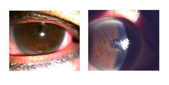 (Right) Patient with severe filamentous keratitis. The cornea lost its luster, and he had difficulty opening his eyes. (Left) After treatment, the cornea became smooth and bright. (Courtesy of Dr. Wang Meng-Chi, Trust Me Eye Center)