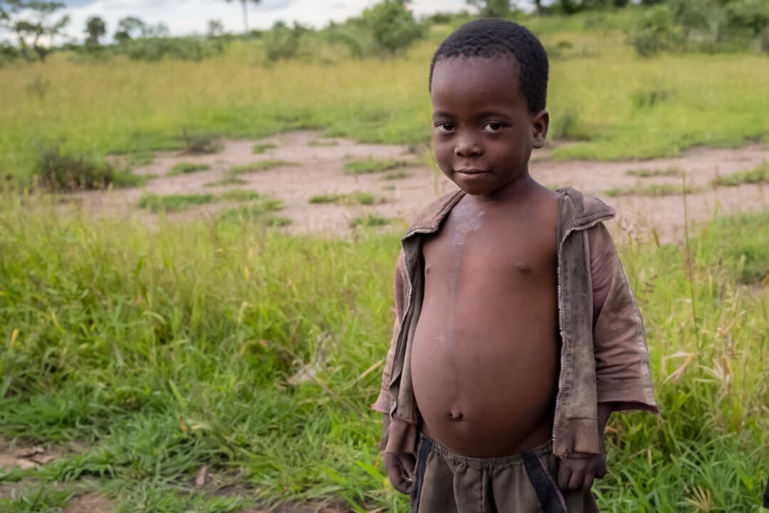 A child with a swollen belly due to a severe lack of food stands outside of Monkey Bay, Malawi, on Feb. 18, 2026. (John Fredricks/The Epoch Times)