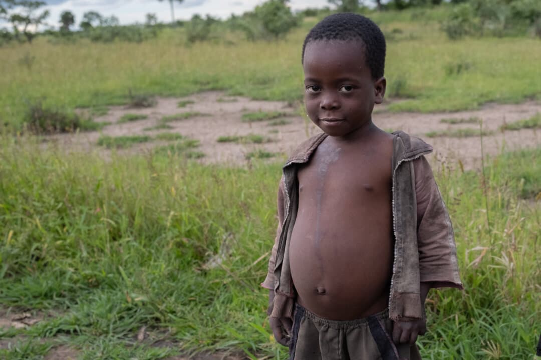 A child with a swollen belly due to a severe lack of food stands outside of Monkey Bay, Malawi, on Feb. 18, 2026. (John Fredricks/The Epoch Times)