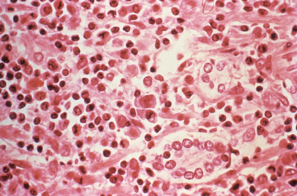 A micrographic study of liver tissue from a Hantavirus pulmonary syndrome (HPS) patient in this undated photo obtained by Reuters, on July 6, 2017. (Centers for Disease Control and Prevention/Reuters)